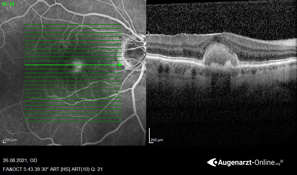 Adulte Vitelliforme Makuladegeneration (AVMD)