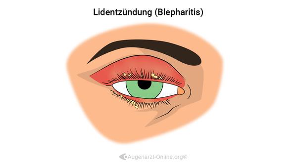 Lidrandentzündung