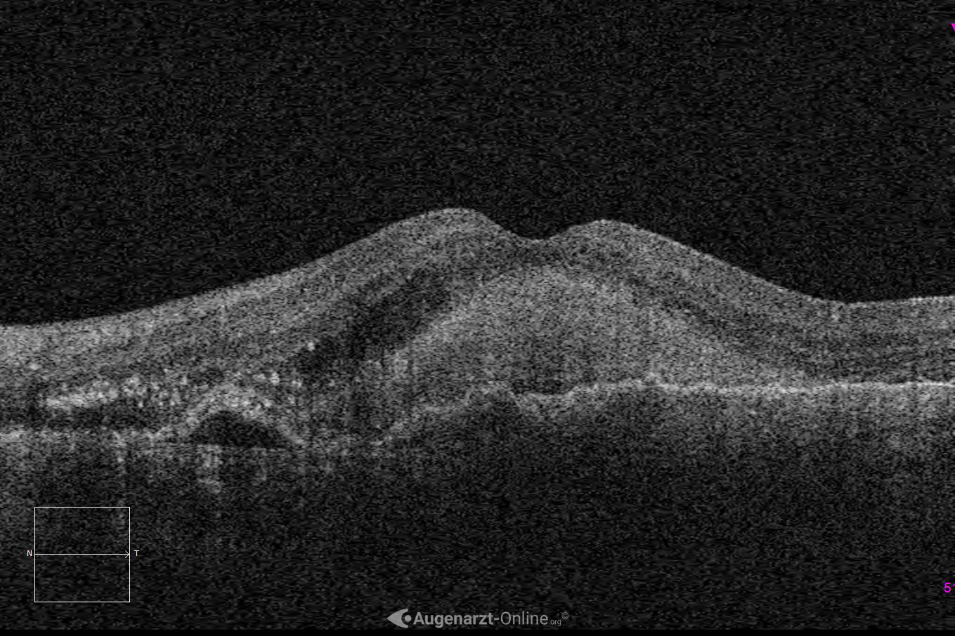 Exsudative AMD