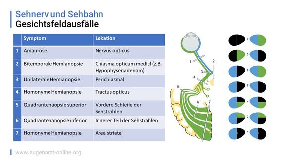 Gesichtsfeldausfälle (Sehnerv und Sehbahn)