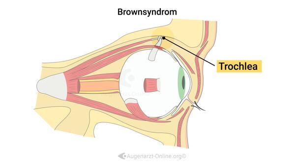 Brown Syndrom