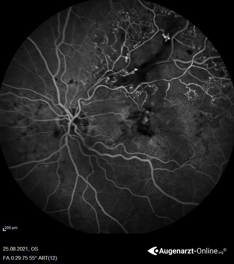Astvenenthrombose