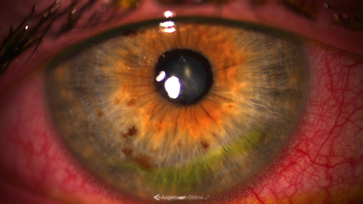 Erosio cornea
