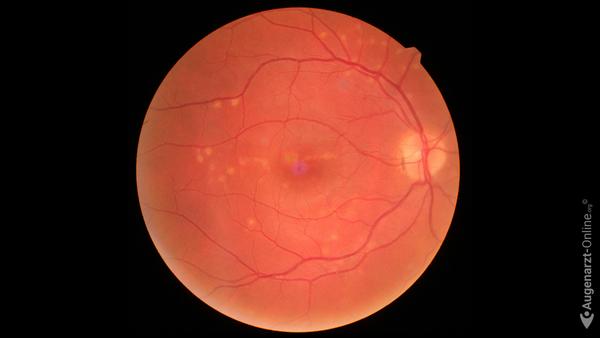 Tamoxifeninduzierte Retinopathie