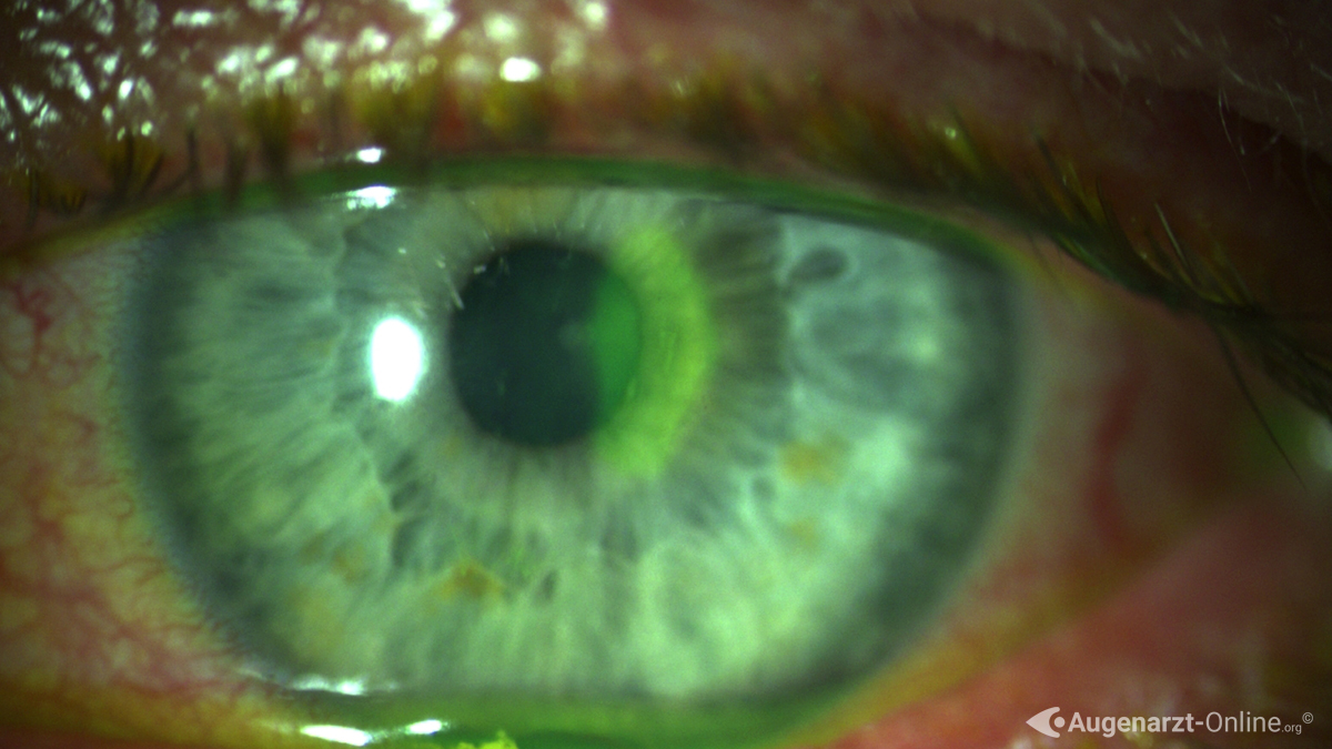 Erosio cornea