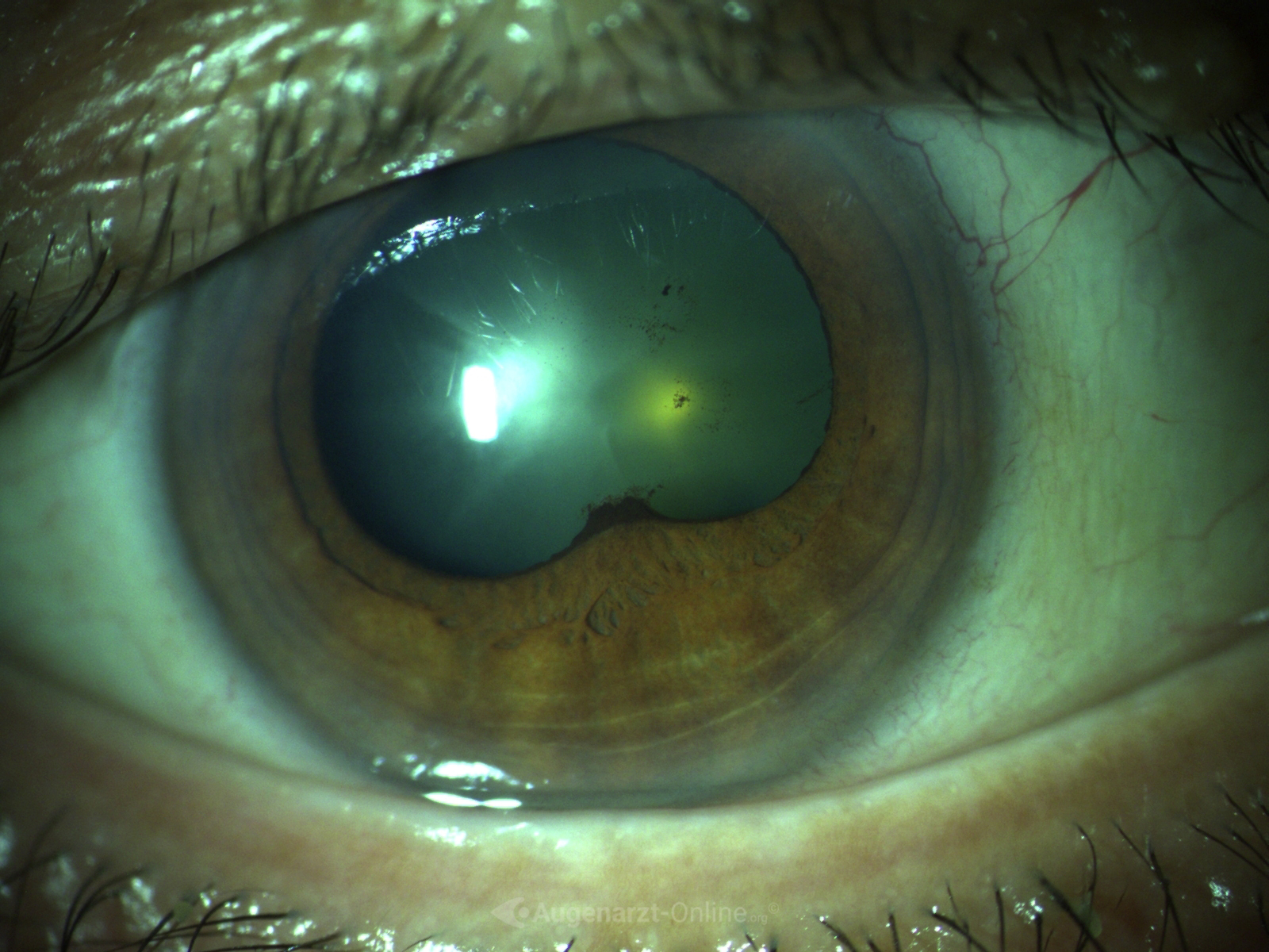 Spaltlampenfoto zu Hintere Synechie (Iris).