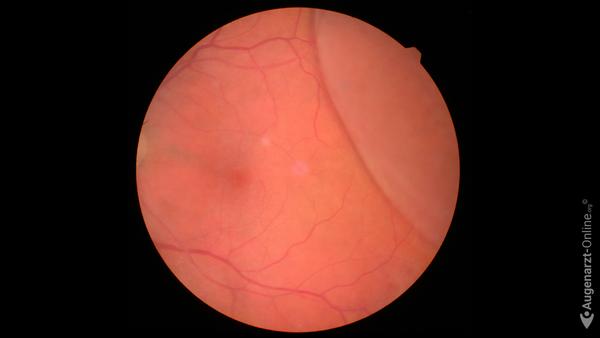 Retinoschisis