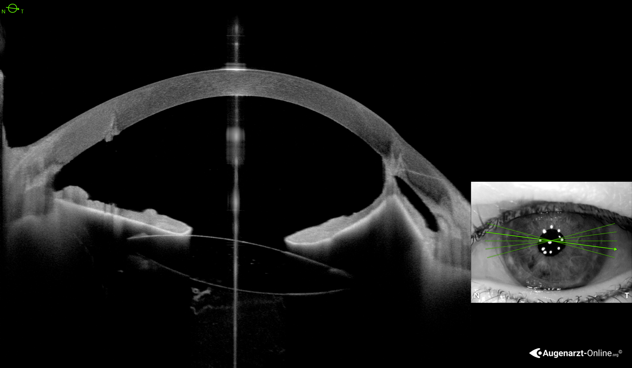 Vordere Synechie nach Keratoplastik