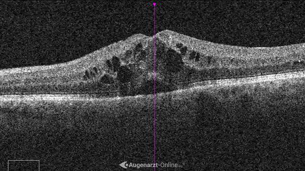 Irvine Gass Syndrom