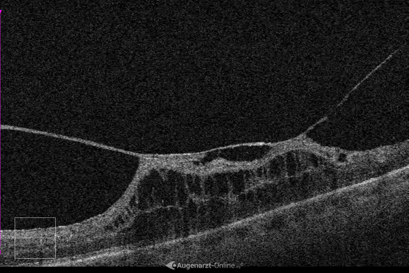 Retinoschisis bei Vitreomakulärer Traktion