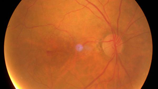 Exsudative AMD