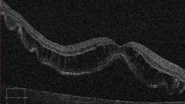 Makula Off Ablatio retinae in OCT.