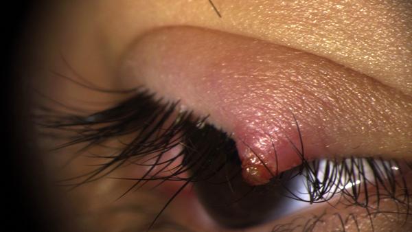 Chalazion in Spaltlampenfoto.