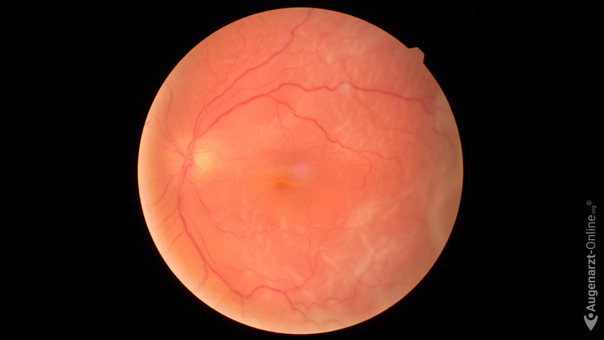 Ablatio retinae (Makula off)