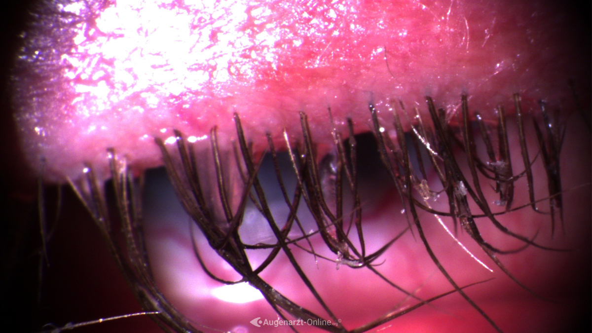 Blepharitis