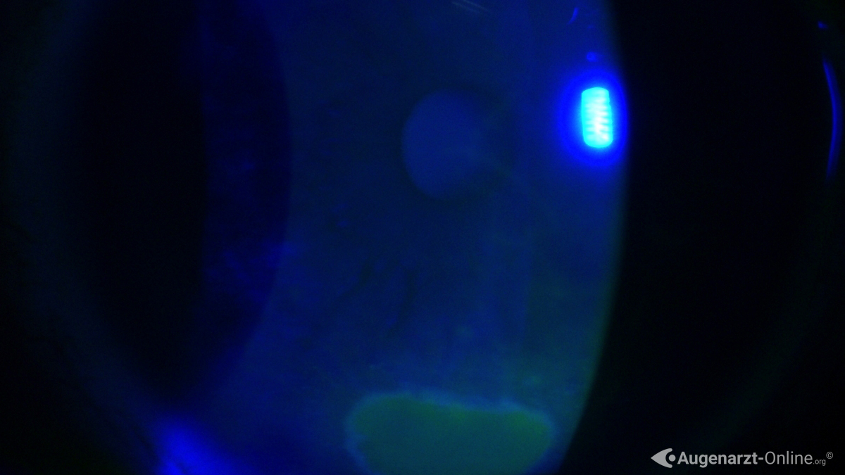 Erosio cornea