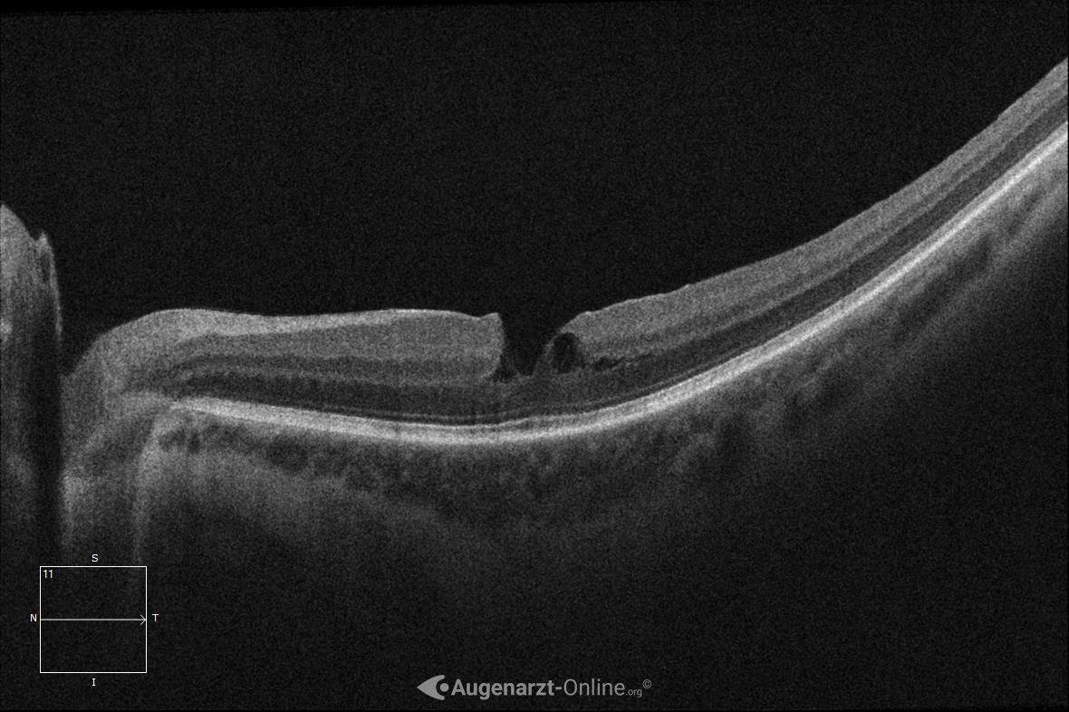 Pseudoforamen